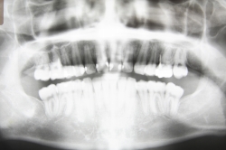 虫歯の深さ、進行状態や他に虫歯や歯周病があった場合には、レントゲンを撮影します。